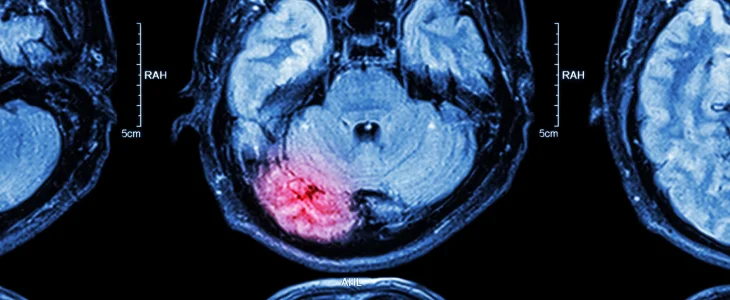 Brain injury scan